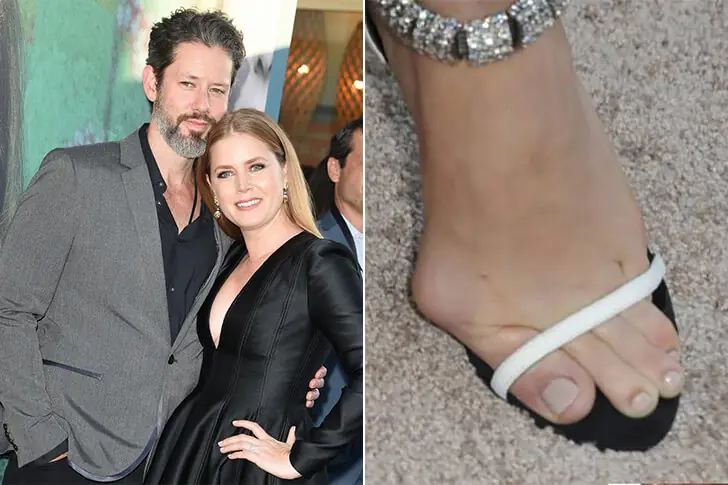 Amy Adams’ Painful-Looking Bunions